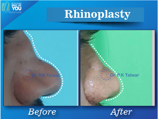 rhinoplasty surgery result